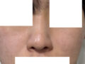 비염수술과 코성형 동시에 받았습니다